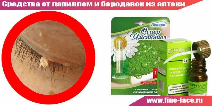 Как удалить бородавку народными средствами