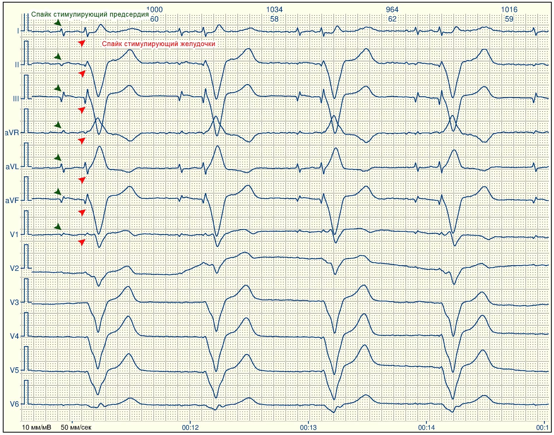 ЭКГ при кардиовертере-дефибрилляторе. Ритм двухкамерного кардиостимулятора на ЭКГ. ЭКГ при искусственном водителе ритма. Фибрилляция предсердий с кардиостимулятором на ЭКГ. Тяжелое экг
