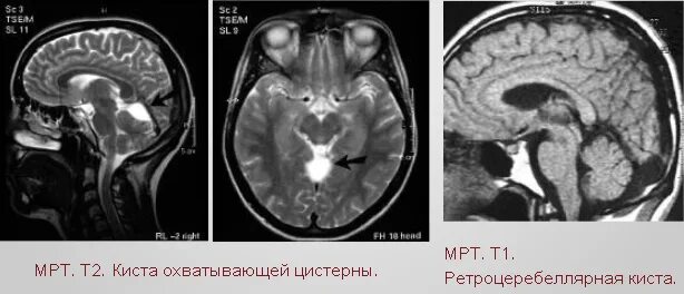 Ретроцеребеллярная арахноидальная киста кт. Ретроцеребеллярная арахноидальная киста в головном мозге мрт. Ретроцеребеллярная цистерна киста. Ретроцеребеллярная арахноидальная киста мрт. Киста головного мозга армия