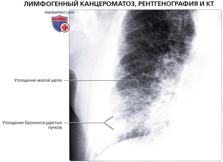 Лимфогенный туберкулез. Лимфогенный канцероматоз легких на кт. Лимфогенный канцероматоз легких рентген. Канцероматоз легких рентген.