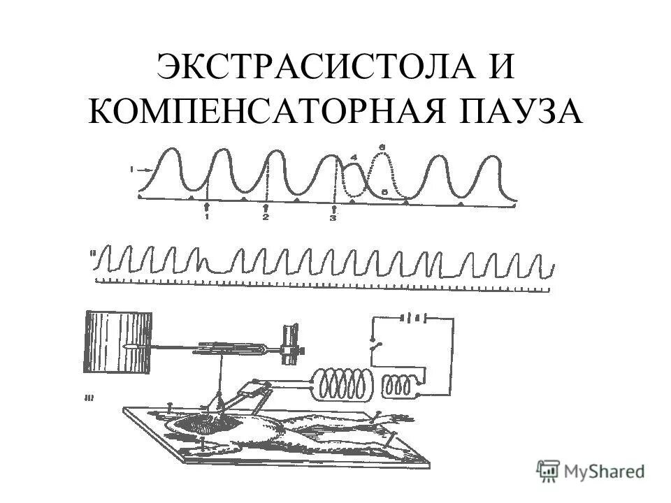 Компенсаторная экстрасистола