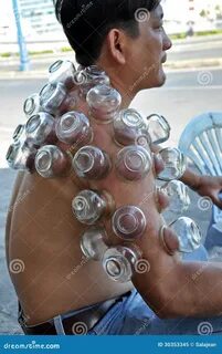 Chinese Cupping Images at Angela Gould blog