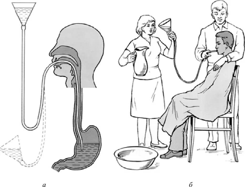 Зондовое промывание желудка алгоритм. Промывание желудка толстым зондом алгоритм. Зондовое промывание желудка при отравлении. Алгоритм промывания желудка оснащение.