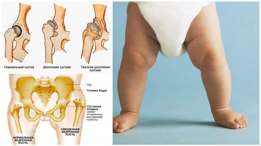 Тазобедренный артрит у ребенка. Дисплазия тазобедренных суставов у новорожденных 2 б. Дисплазия тазобедренных суставов 3ст. Дисплазия тазобедренных суставов у новорожденных 1б. Дисплазия ТБС У младенца.