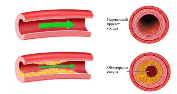 Атеросклеротическая болезнь сосудов. Влияние никотина на кровеносные сосуды. Сужение просвета сосудов. Сужение просвета сосуда (стеноз). Гуморальная регуляция просвета сосудов.