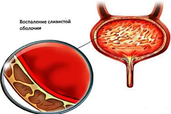 Зуд в мочеиспускательном канале. Кишечная палочка в мочевом пузыре. Бактерии в мочевом пузып. Воспаление мочевого пузыря.