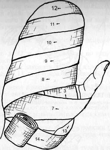 Наложение повязки варежка алгоритм. Наложение повязки варежка. Перевязка варежка алгоритм. Десмургия повязка варежка. Наложение повязки на кисть варежка.
