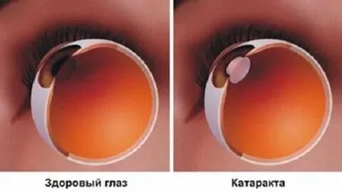 Отзывы после катаракты