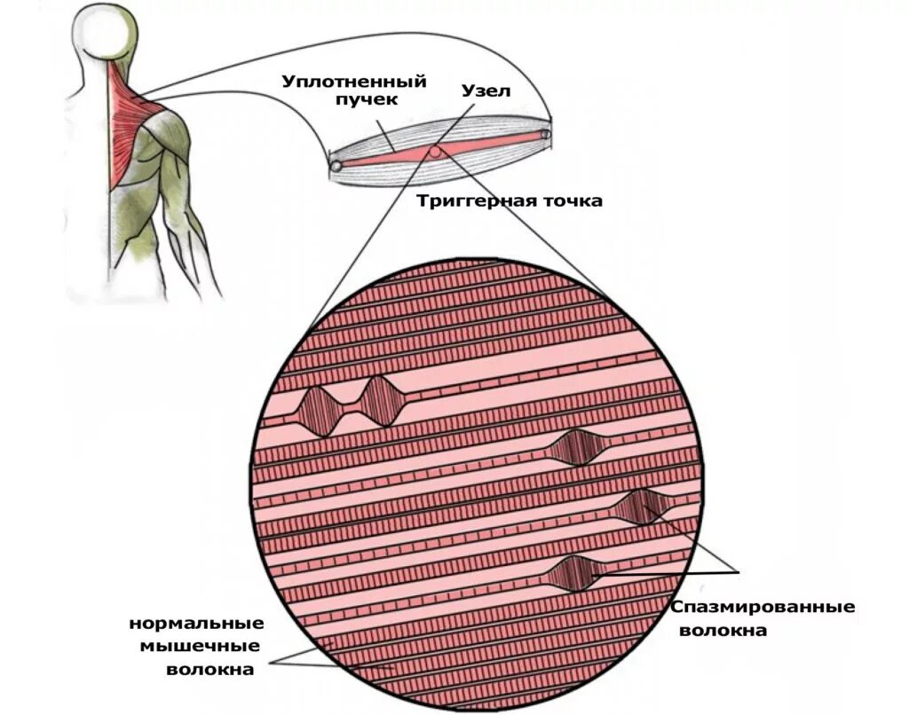 Триггерные точки. Триггерная точка в мышцах. Мышечные узлы. Триггерные узлы в мышцах. Триггерные точки это простыми словами