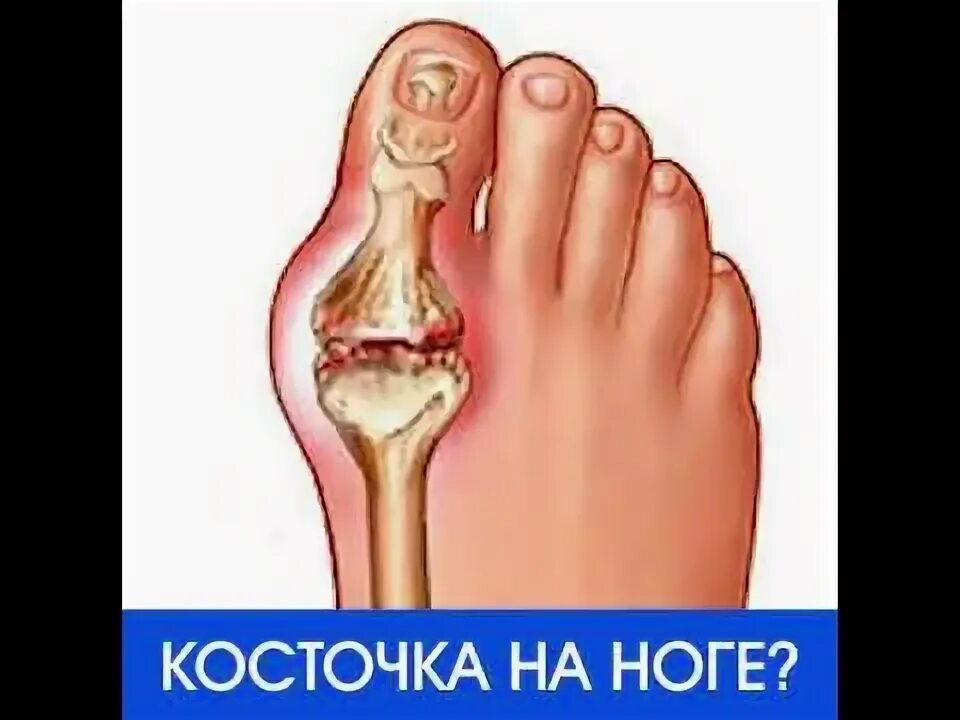 Боль в плече в результате системных заболеваний соединительной ткани Пикабу Дзен