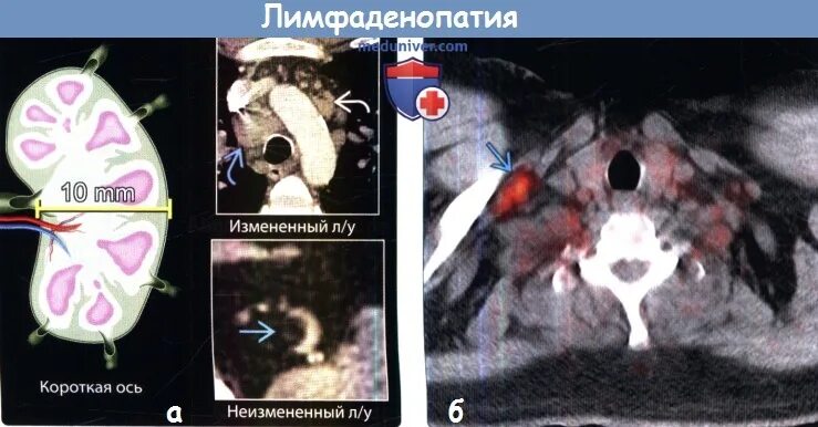 Короткая ось лимфоузла. ПЭТ кт лимфатических узлов. Внутрилегочные лимфоузлы на кт кт. Внутригрудные лимфоузлы на кт. Увеличенные внутригрудные лимфоузлы на кт.
