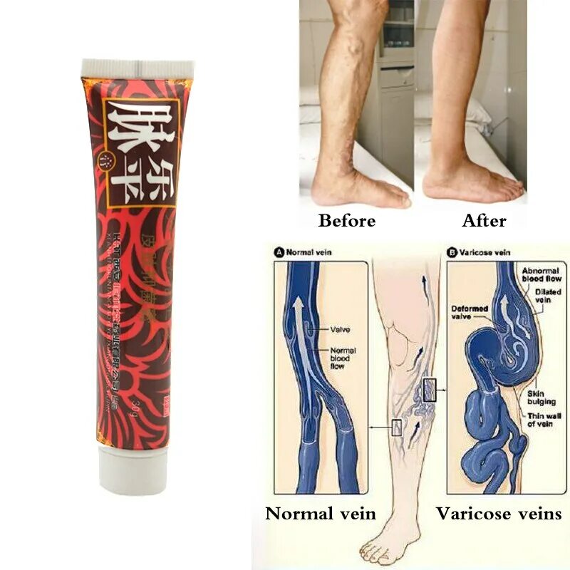 Мази от вен на ногах недорогие. Varicose Veins Ointment от варикоза.