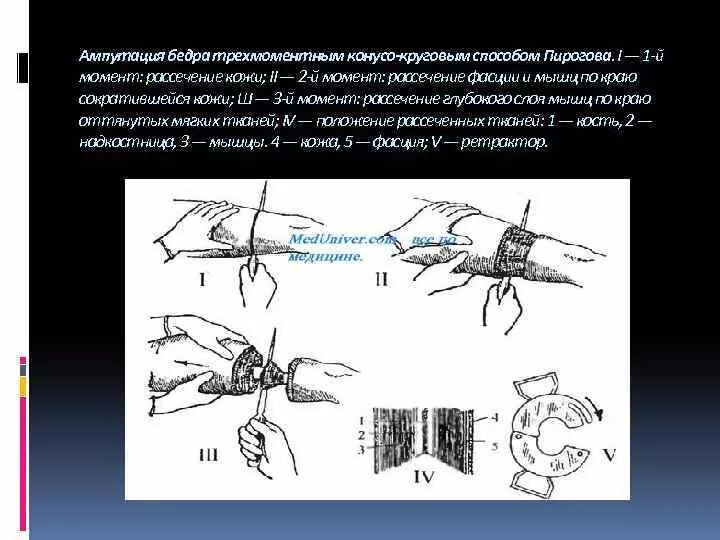 Лоскутная ампутация. Трехмоментная ампутация бедра по Пирогову инструменты. Трехмоментный круговой способ ампутации бедра. Трехмоментная ампутация бедра по н.и Пирогову. Ампутация бедра по Пирогову.