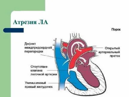 Атрезия артерии
