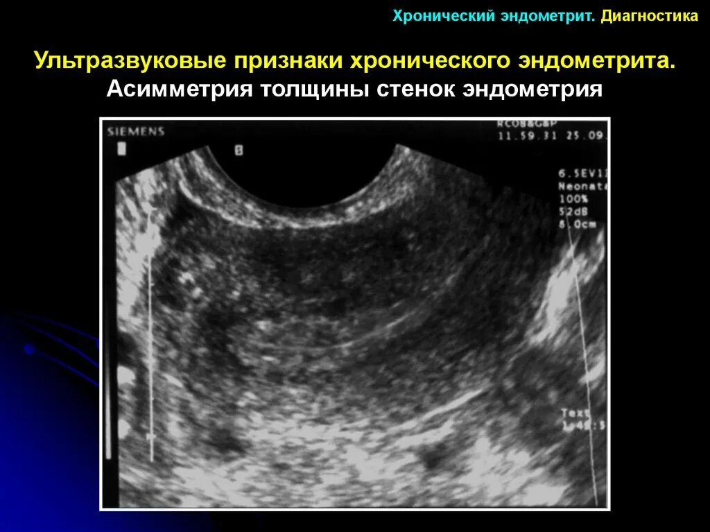 Послеродовый эндометрит УЗИ. Послеродовой эндометрит КРС. Хронический эндометрит. УЗИ признаки послеродового эндометрита.