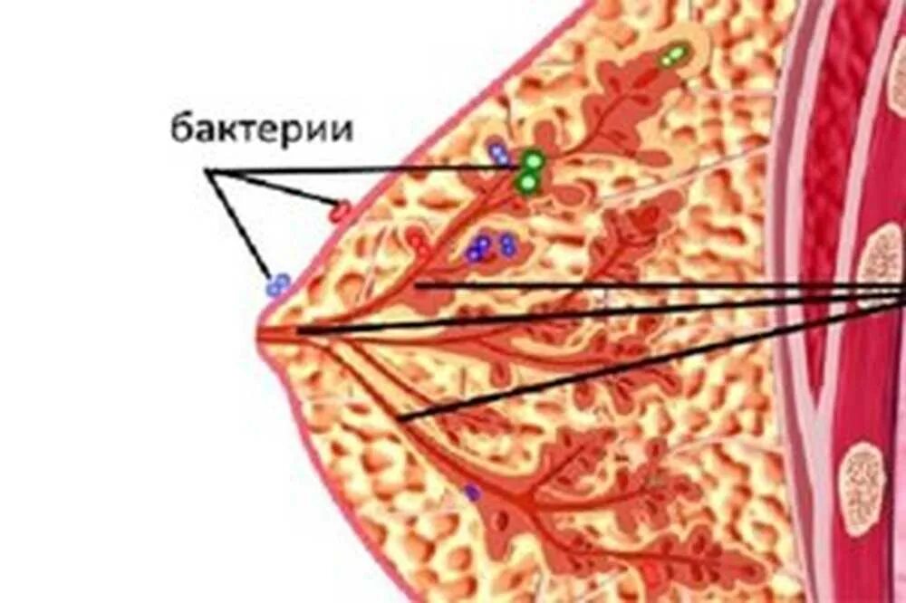 Послеродовый мастит. Гнойный послеродовый мастит. Острый послеродовой мастит. Нелактационный мастит. Острый инфильтративный мастит.