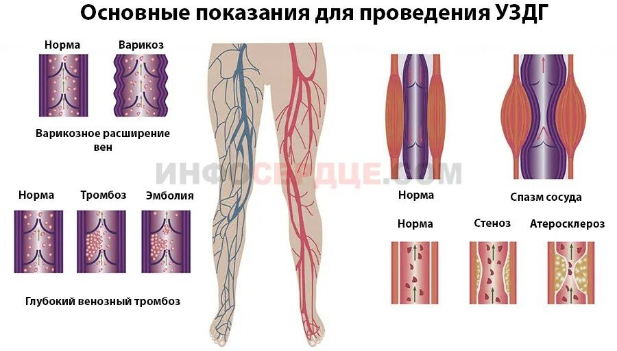 Дуплекс нижних конечностей. Варикозное расширение вен нижних конечностей УЗДГ. Ультразвуковая допплерография артерий нижних конечностей. Дуплексное исследование вен нижних конечностей. Расшифровка сканирования вен нижних конечностей.