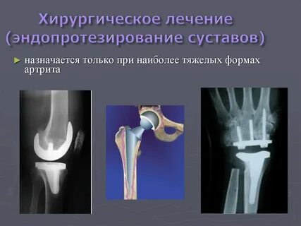 Эндопротезирование суставов