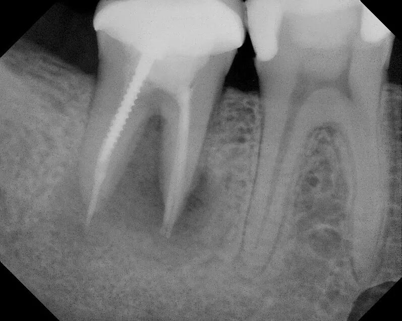 Воспаление канала зуба. Периапикальный периодонтит. Хронический апикальный периодонтит рентген. Периапикальный абсцесс. Фиброзный периодонтит рентгенограмма.