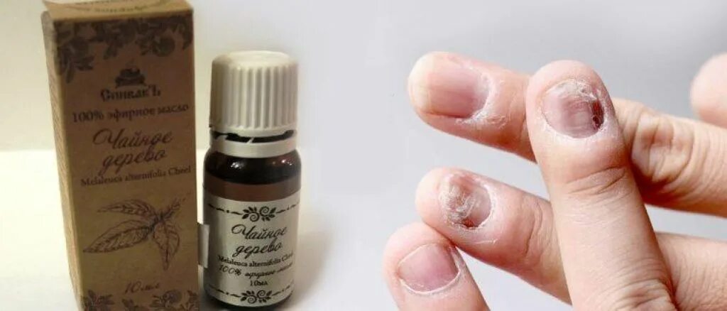 чайное дерево для ногтей при онихолизисе