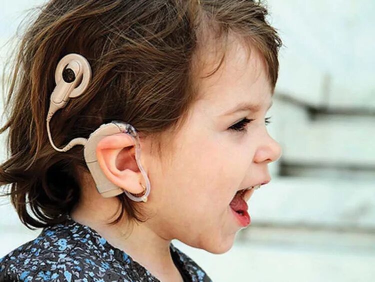 The hearing over. Аппарат Cochlear кохлеарный. Аппарат для глухих кохлеарная имплантация. Грэм Кларк кохлеарная имплантация. Слуховой аппарат для детей.