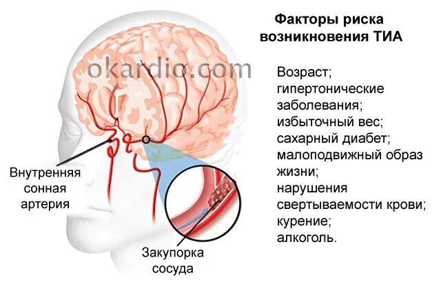 Предынсультное состояние. Предъинсультное состояние. Симптомы прединсультного состояния. Пред инсулное состояние.