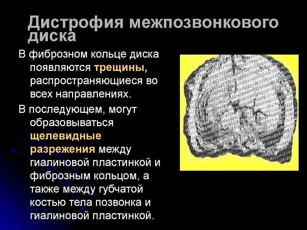 Фиссура фиброзного кольца межпозвоночного диска что это. Трещина фиброзного кольца. Трещина фебрального кольца. Дегенерация межпозвонкового диска.