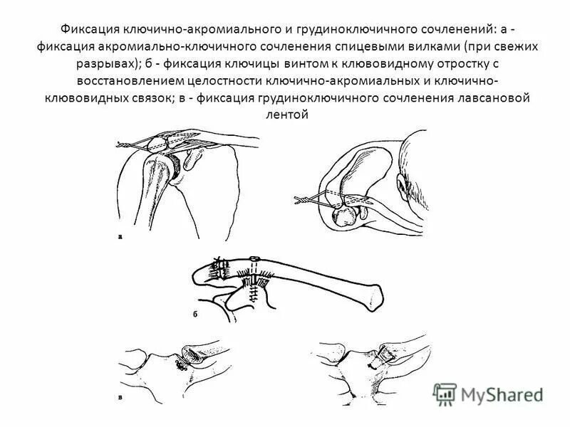 разрыв ключично акромиального сочленения операция. пластина при разрыве акс. растяжение акс плечевого сустава. разрыв акромиально-ключичного сочленения плечевого сустава операция. акромиально-ключичный сустав разрыв связок.