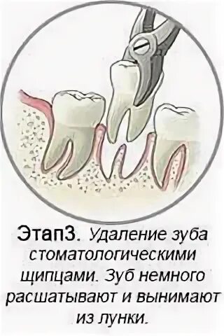 После удаления зуба через сколько убирать тампон. Заживление удаленного зуба мудрости. Удаленный зуб заживает. Лунка удаленного зуба мудрости. Заживление десны после выдергивания зуба.