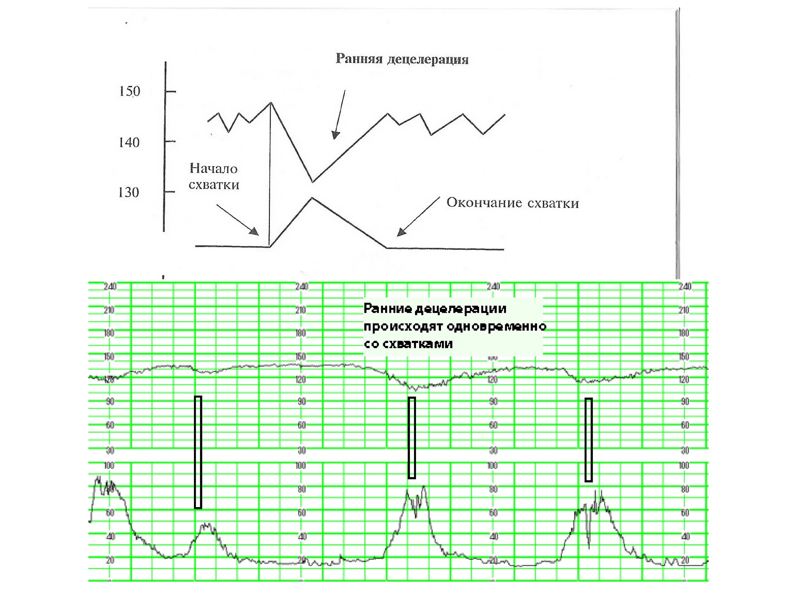 Схватки хиггса. Ранние децелерации. Ложные схватки на КТГ. Как на КТГ показывает схватки. График КТГ со схватками.