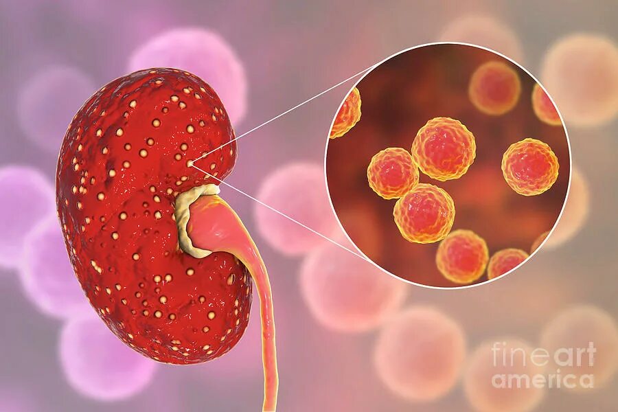 Enterococcus пиелонефрит. Острый пиелонефрит кишечная палочка. Бактериальная инфекция почек. Орви почки