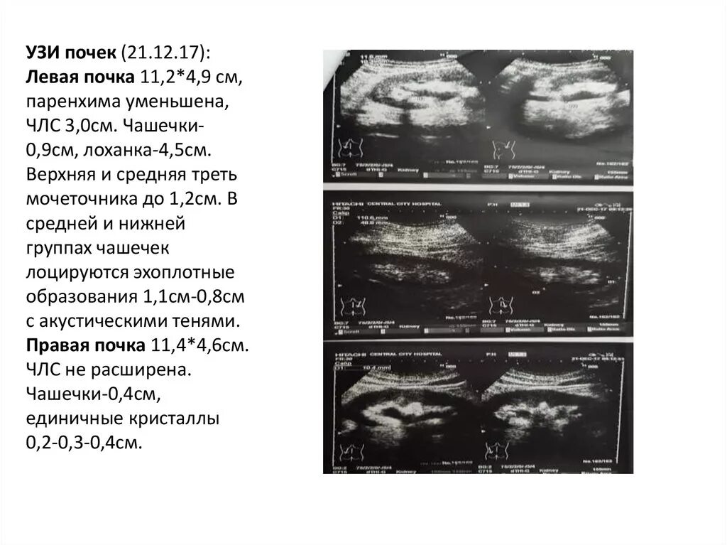 Расширенная члс. Почка расширенное ЧЛС УЗИ. Нормы чашечно-лоханочной системы у детей УЗИ. Расширение ЧЛС почек на УЗИ. Расширение чашечно лоханочной системы протокол УЗИ.