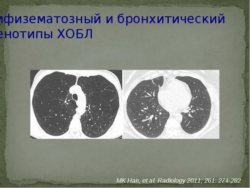 Хроническими болезнями легких астмой. Кт признаки бронхиальной астмы. Кт картина бронхиальной астмы. Эмфизематозный ХОБЛ. Кт при бронхиальной астме.