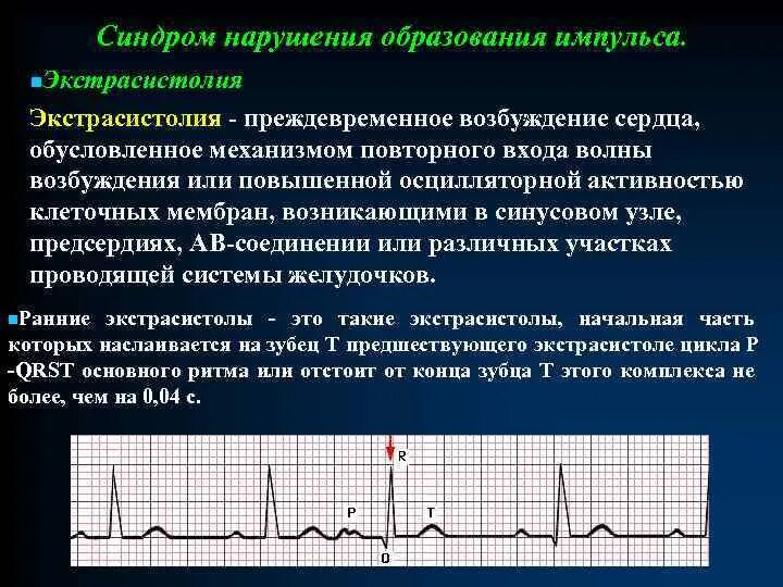 Синусовая экстрасистолия на ЭКГ. Экстрасистолия при wpw синдроме. Экстрасистолия при wpw. Экстрасистолия на ЭКГ. Экстрасистолы врачам