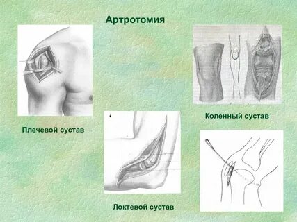 Резекция коленного сустава