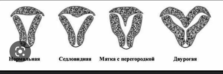 Седловидная матка форум. Аномалия развития матки седловидная. Седловидная матка и двурогая матка. Двурогая матка на узи. Двурогая седловидная матка.