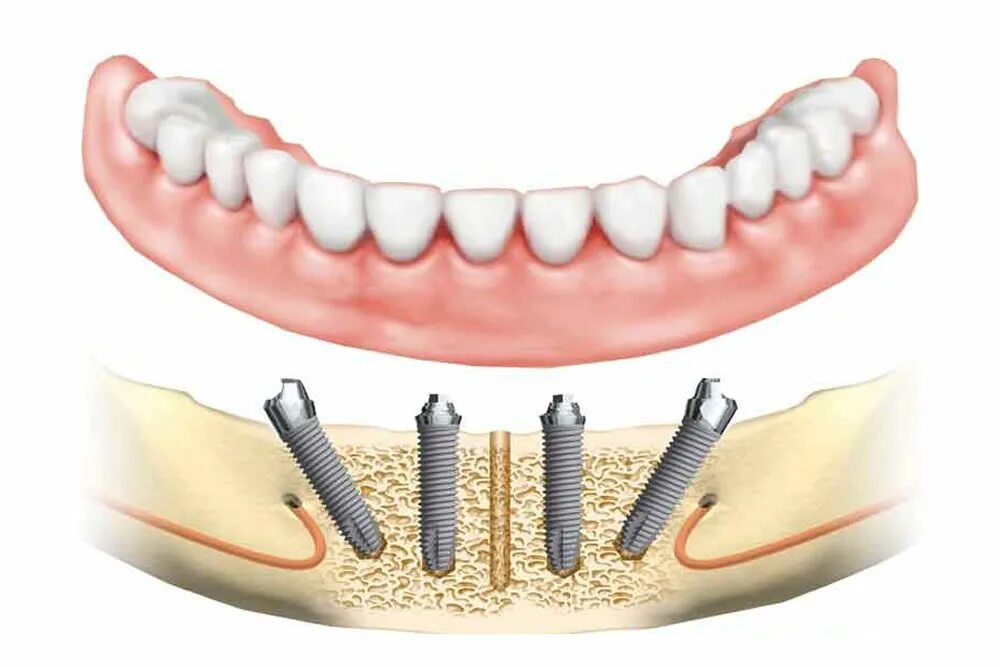 Имплантация all on 4 челюсть. Имплантация челюсти на 4 имплантах. Протез нижней челюсти на 4 имплантах.