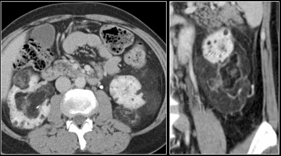 Кистозно расширенная железа. Гемангиомиолипома почки кт.