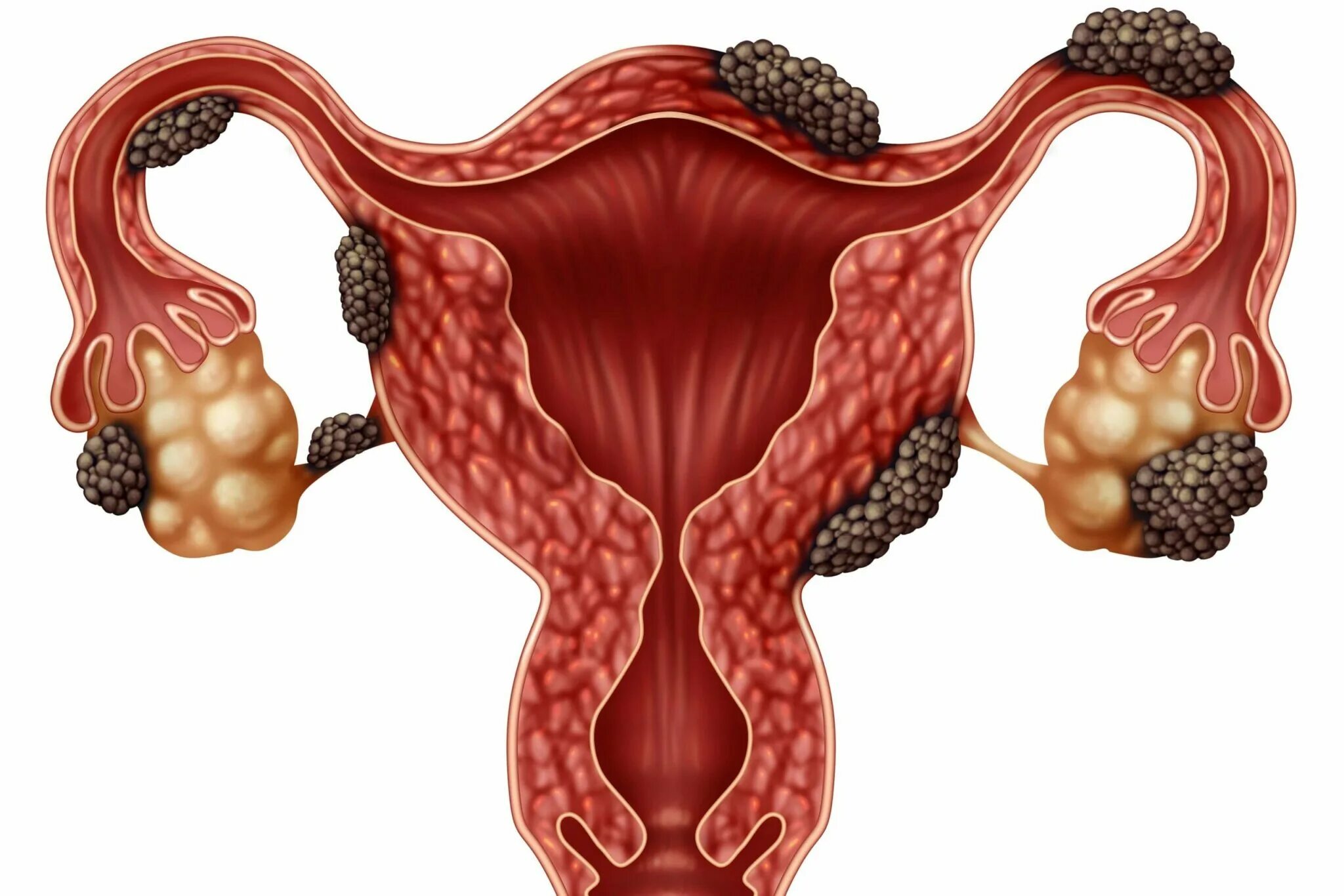 Народные лечения эндометриоза у женщин. Овариальный эндометриоз. Эндометриомы яичников.