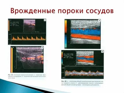 Врожденный сосудистый порок