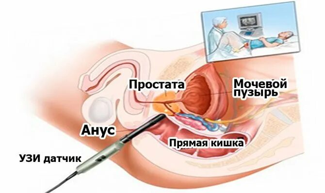 Узи простаты ректально. Трансректальное УЗИ предстательной железы. Трансректальное УЗИ простаты (трузи). УЗИ трузи предстательной железы. УЗИ предстательной железы ректально.