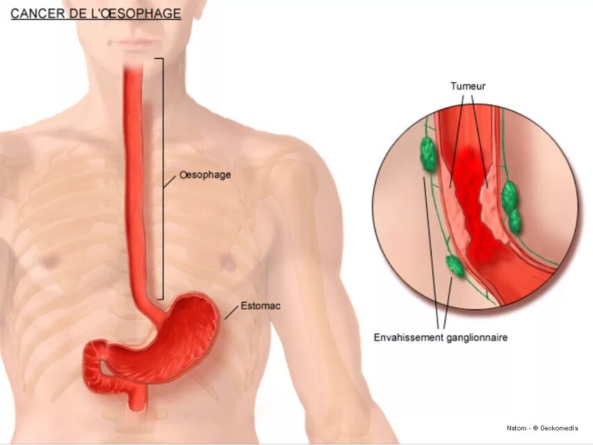 Злокачественные опухоли пищевода. Ракпешевода. Раковые опухоли в пищеводе. Строение опухоли пищевода.
