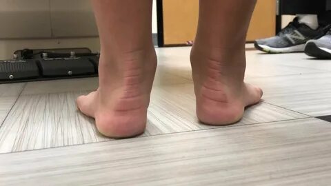 Flat footed