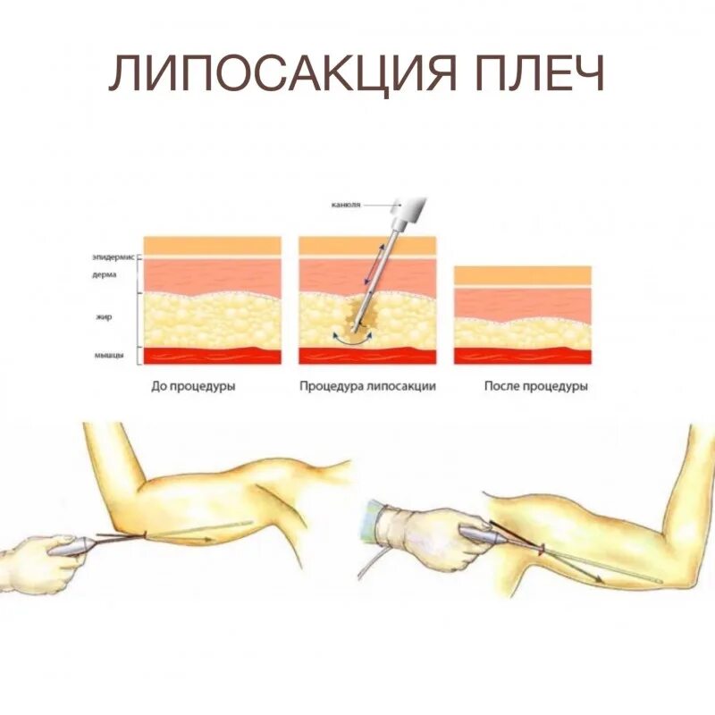 Липосакция плеч до и после отзывы Липосакция фото до и после липоаспирация фото липосакция бедер живота фото