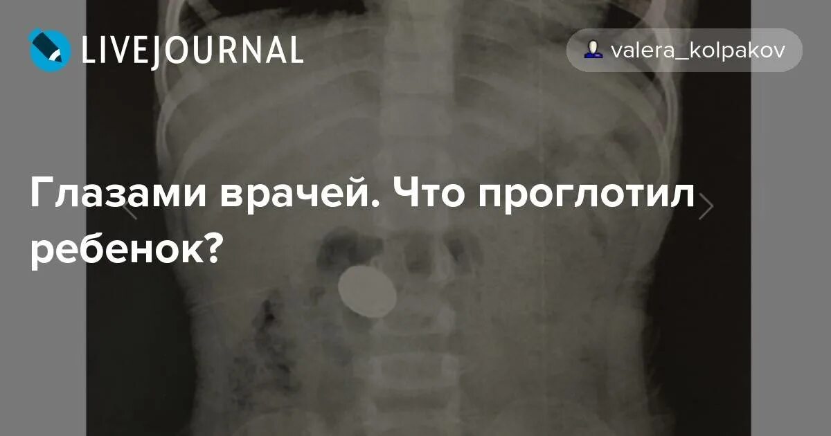 Как узнать проглотил ребенок. Если ребёнок проглотил пластмассовую деталь что делать. инородные тела на рентгенограмме. ребёнок проглотил монету. что делать если ребенок проглотил монету.