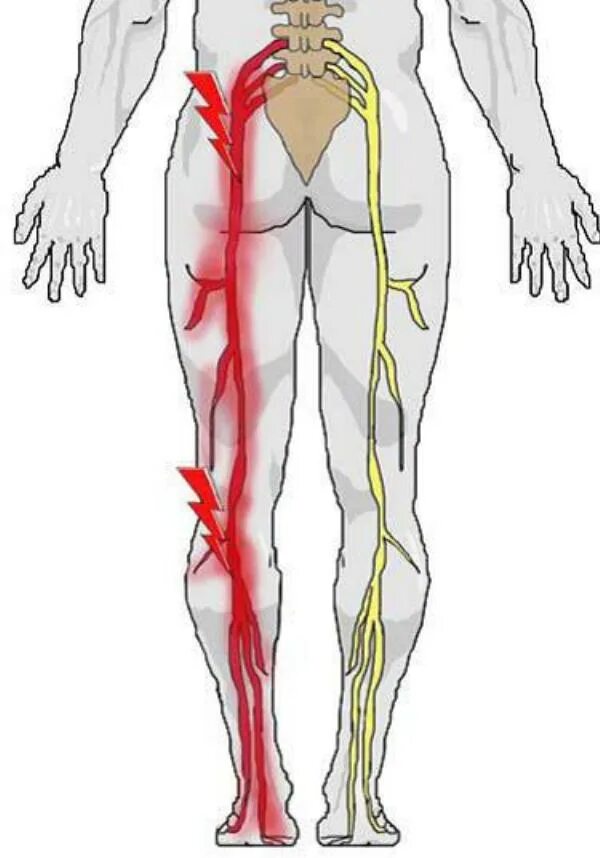 Боли в спине седалищный нерв. Седалищный нерв. Защемление седалищного нерва s1. Схема защемления седалищного нерва. Защемило седалищный нерв симптомы.