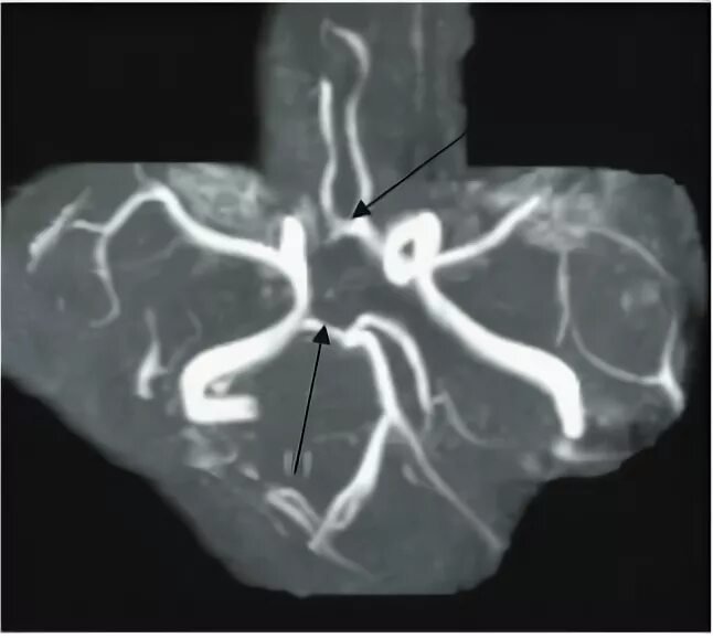 Правая задняя трифуркация. Трифуркация правой ВСА. Двусторонняя задняя трифуркация. Передняя трифуркация правой ВСА.