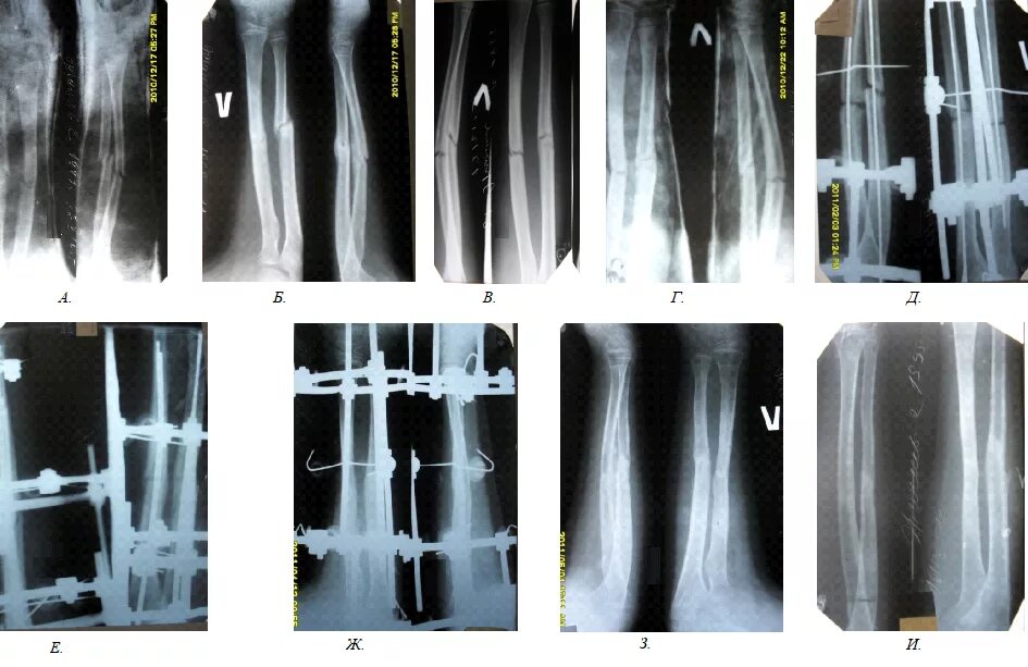 Эндостальная костная мозоль рентген. Заживления перелома костей на рентген. Срастание костей после перелома рентген. Сросшийся перелом на рентгене.