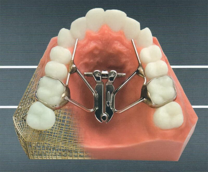 Benefit аппарат ортодонтия. Хаас аппарат ортодонтия. Пендюлюм аппарат ортодонтия. Аппарат хасса