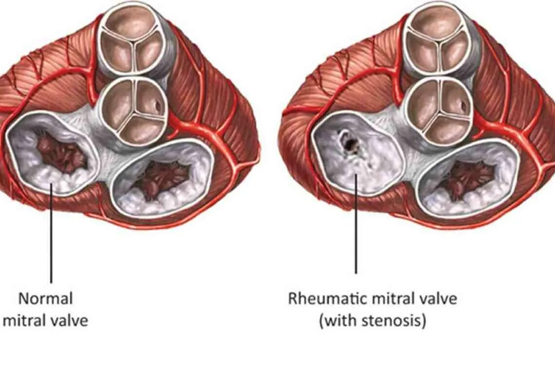 Поражение митрального клапана. Стеноз митрального клапана сердца. Ревматизм митральный стеноз. Ревматизм и стеноз митрального клапана. Болезнь сердца митральный стеноз.
